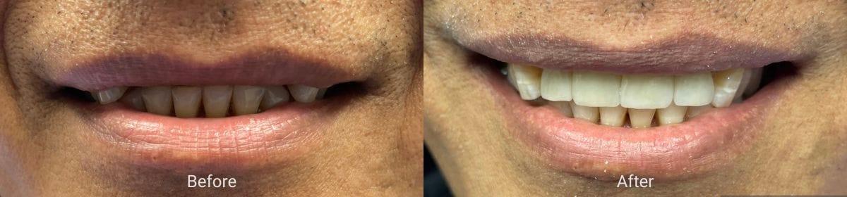 Hillsboro Dental smile transformation 1