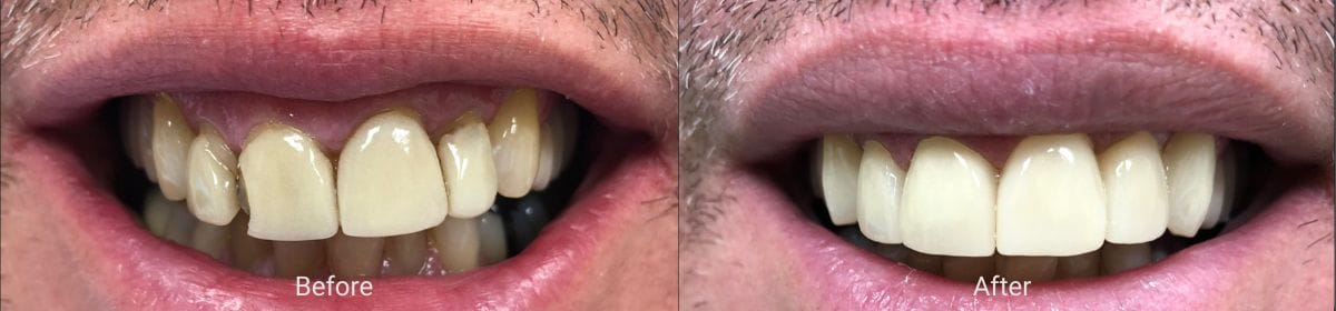 Hillsboro Dental smile transformation 2