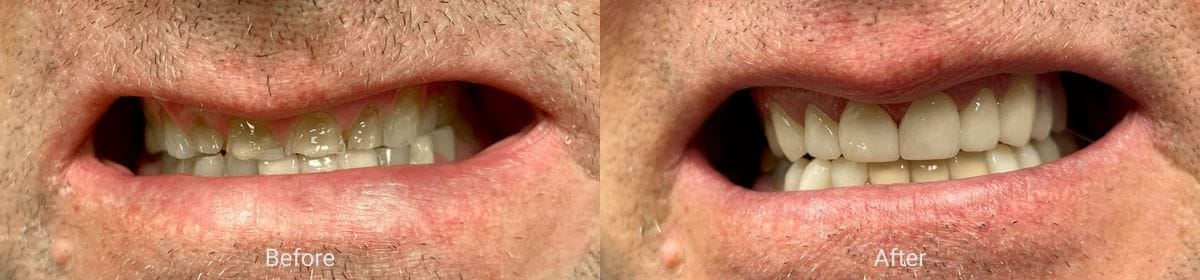 Hillsboro Dental smile transformation 3